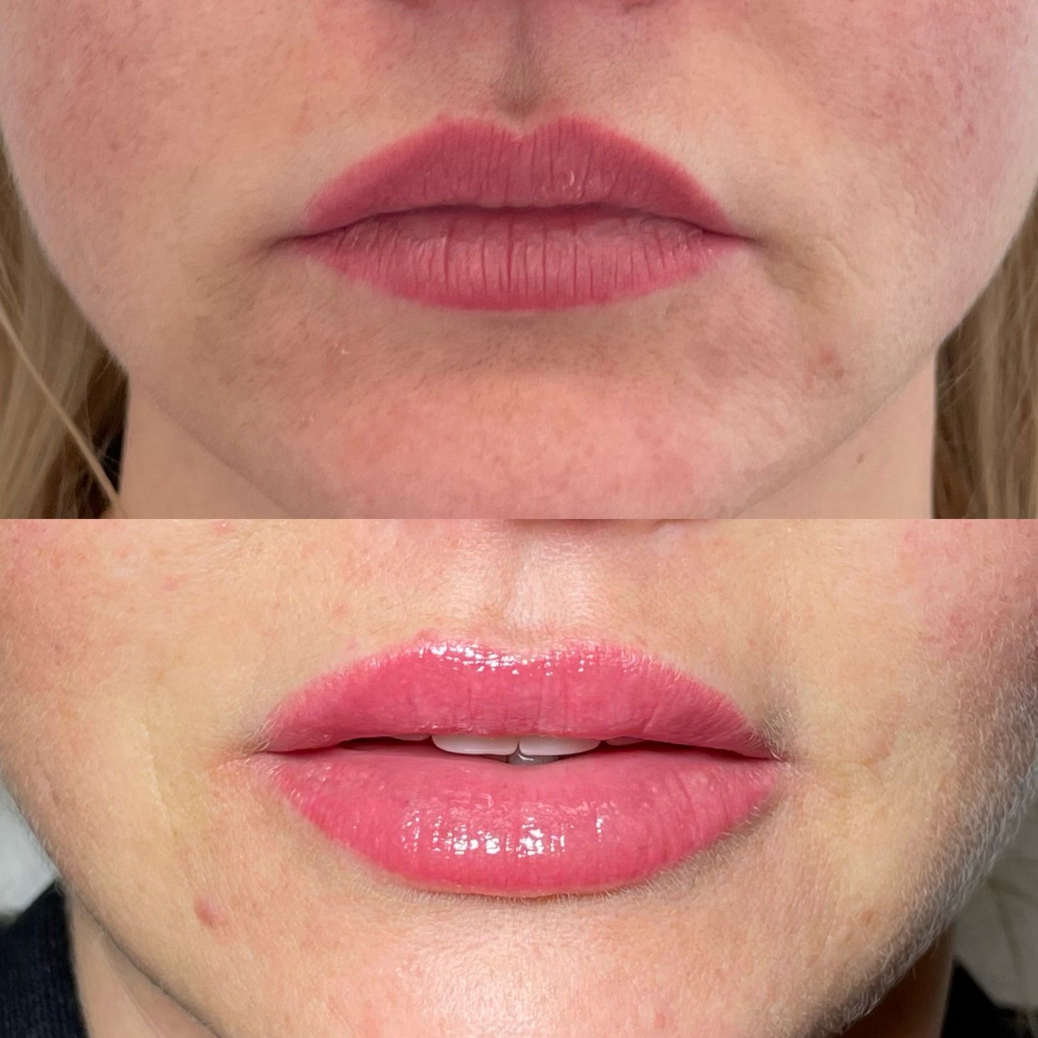 Natural Lip Enhancement in London: Refined Lip Filler Treatments for Subtle Results