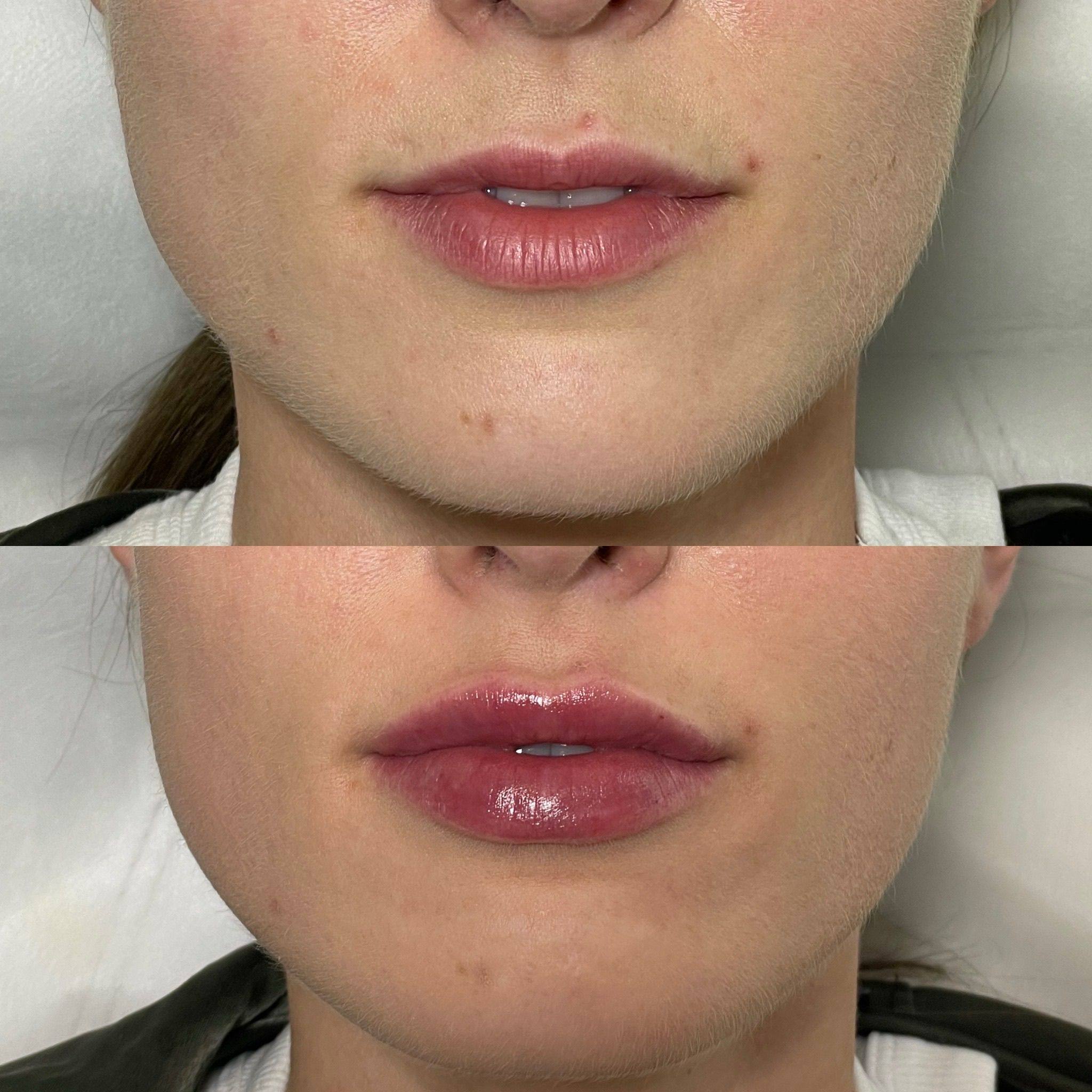 Natural Lip Enhancement in London: Refined Lip Filler Treatments for Subtle Results