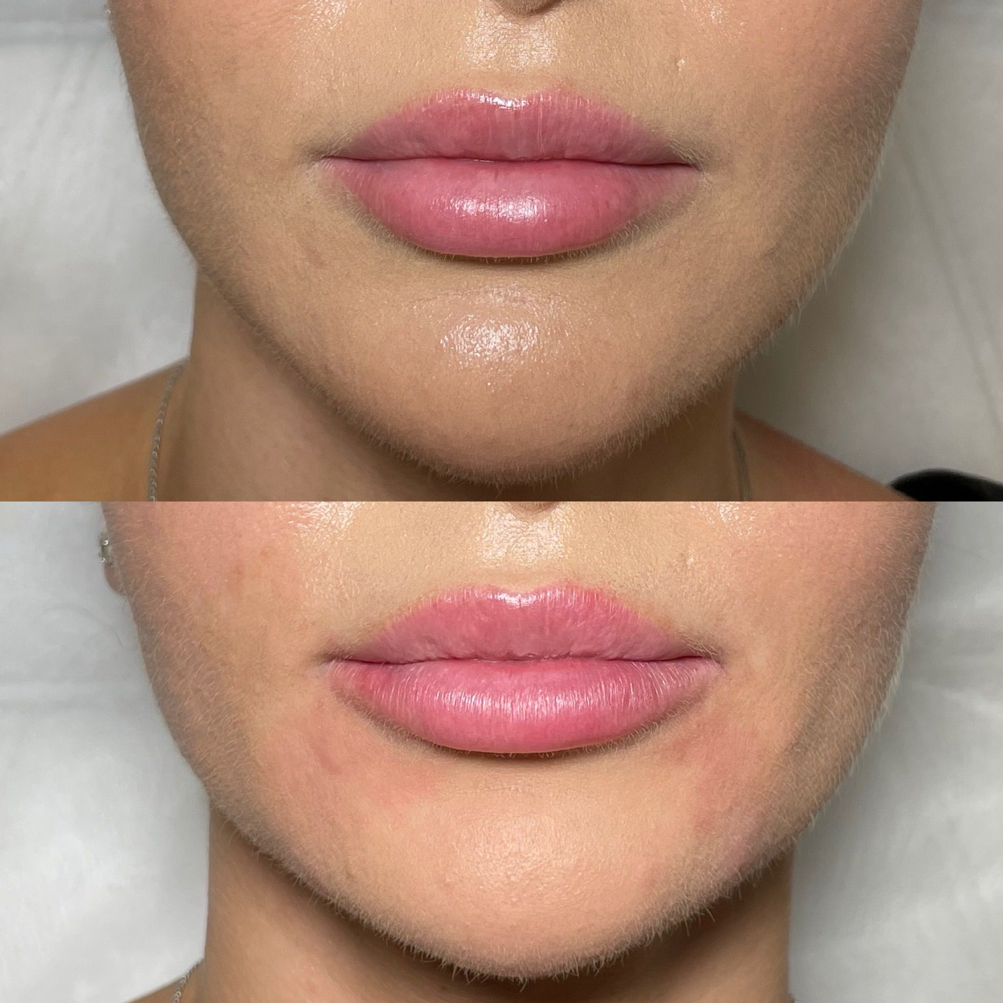 Natural Lip Enhancement in London: Refined Lip Filler Treatments for Subtle Results